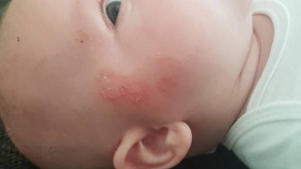 Bild zu Ringelflechte - Baby Forum - Allgemeine Themen