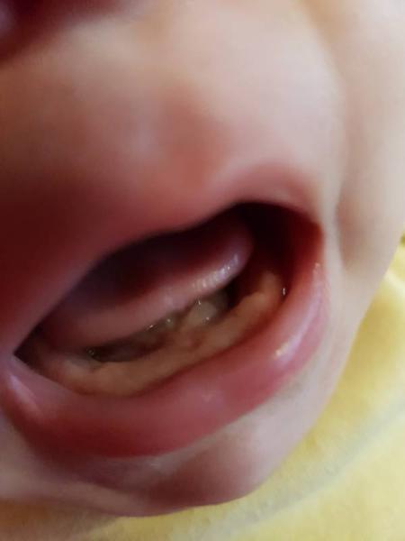 Bild zu Zahndurchbruch ? - Baby Forum - Allgemeine Themen