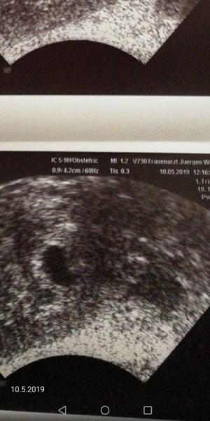 Bild zu Ultraschall Frucht Höhle... 1 oder 2? - Baby Forum - Allgemeine Themen