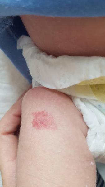 Bild zu roter Fleck am Bein - Feuermal? - Baby Forum - Allgemeine Themen