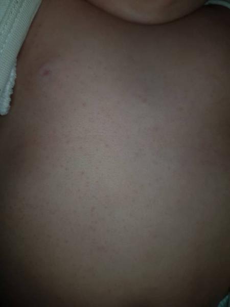 Bild zu Pickelchen baby - Baby Forum - Allgemeine Themen