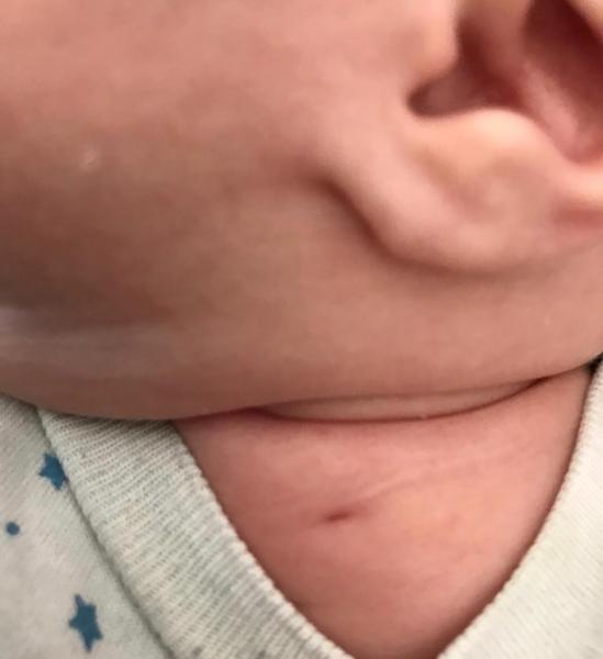 Bild zu Kerbe nach Pickel - Baby Forum - Allgemeine Themen