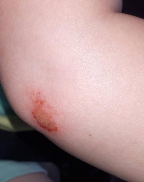 Bild zu Schürfwunde - Baby Forum - Allgemeine Themen