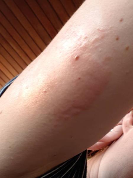 Bild zu Wespenstich - Baby Forum - Allgemeine Themen