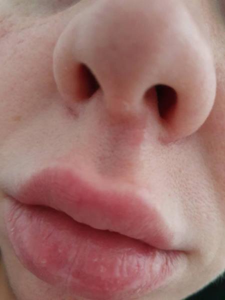 Bild zu Herpes & 5 Wochen altes baby - Baby Forum - Allgemeine Themen