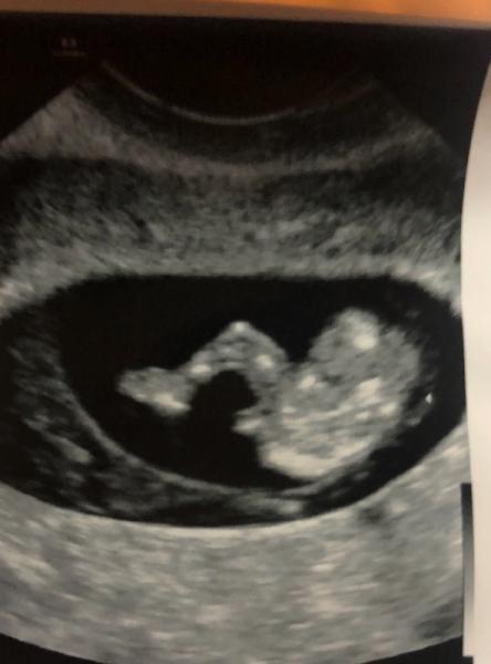Bild zu Junge oder Mädchen? 10+5 - Baby Forum - Allgemeine Themen