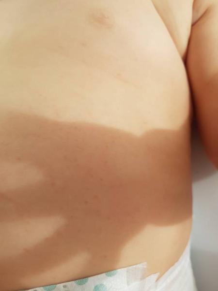 Bild zu Ausschlag ? - Baby Forum - Allgemeine Themen