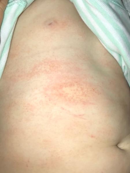 Bild zu Neurodermitis Hilfe!!! - Baby Forum - Allgemeine Themen