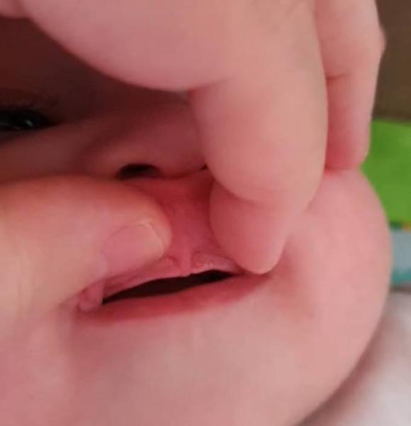 Bild zu Zu kleines / tiefes Lippenbändchen - Baby Forum - Allgemeine Themen