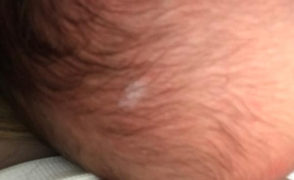 Bild zu Weißer Fleck ? - Baby Forum - Allgemeine Themen