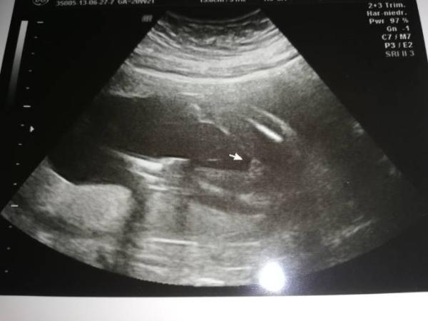 Bild zu Ultraschall, was erkennt ihr? - Baby Forum - Allgemeine Themen