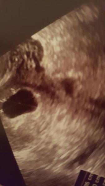 Bild zu 7+0 nur Fruchthülle - Baby Forum - Allgemeine Themen