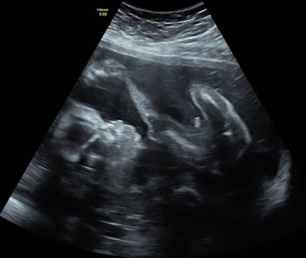 Bild zu Geschlecht M oder W - was meint Ihr? - Baby Forum - Allgemeine Themen