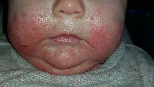 Bild zu Hautausschlag - Baby Forum - Allgemeine Themen