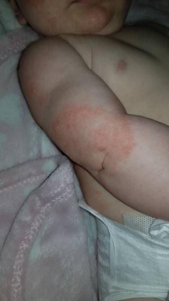 Bild zu Hautausschlag ? Neurodermitis? - Baby Forum - Allgemeine Themen
