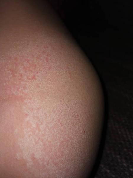Bild zu Undefinierbarer "ausschlag" /Schuppenflechte - Baby Forum - Allgemeine Themen