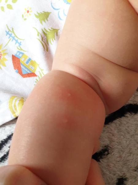 Bild zu Baby Haut rote Flecken mit weißem Punkt Pickel Beine - Baby Forum - Allgemeine Themen