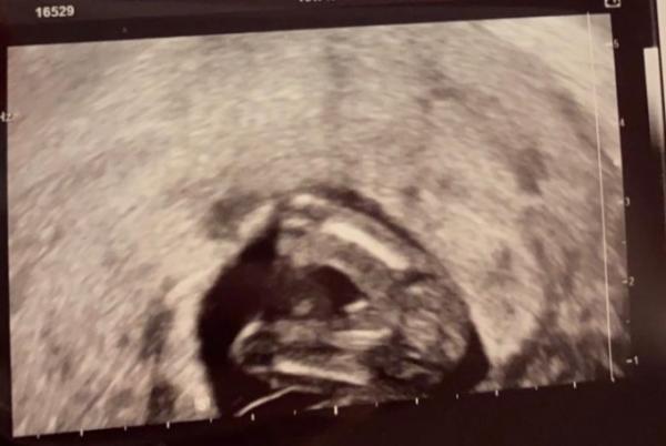 Bild zu Geschlecht Bestimmung - Baby Forum - Allgemeine Themen