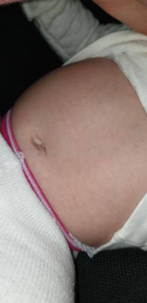 Bild zu Sind das Hitzepickel? - Baby Forum - Allgemeine Themen