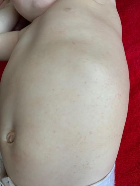Bild zu Hautausschlag / Petechien ? - Baby Forum - Allgemeine Themen