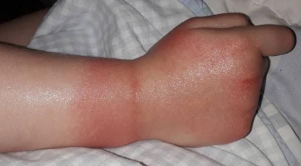 Bild zu Hilfe! Kind Ausschlag. - Baby Forum - Allgemeine Themen