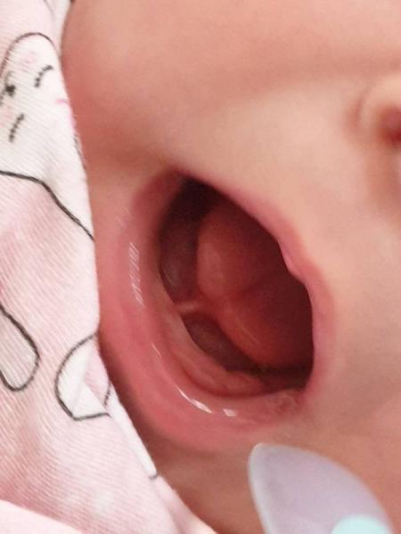 Bild zu Zungenbändchen - Baby Forum - Allgemeine Themen