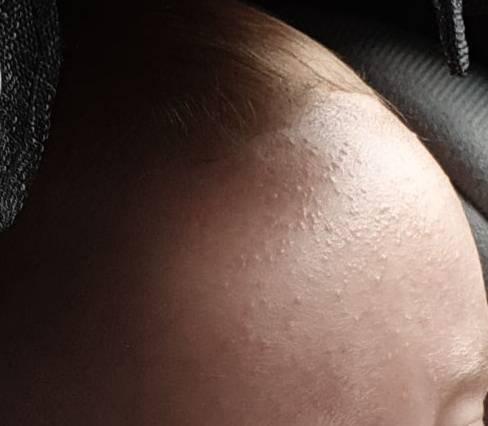 Bild zu Erfahrungen mit dem Hautzustand? (siehe Bild) - Baby Forum - Allgemeine Themen