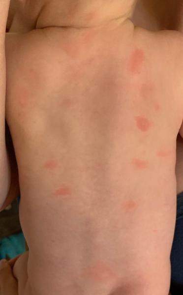 Bild zu Hautausschlag Baby 6 Monate - Baby Forum - Allgemeine Themen