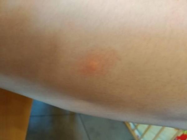 Bild zu Borreliose? - Baby Forum - Allgemeine Themen