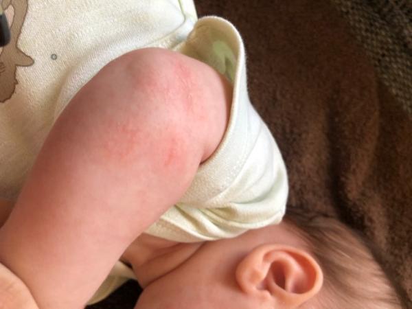 Bild zu Neurodermitis? - Baby Forum - Allgemeine Themen