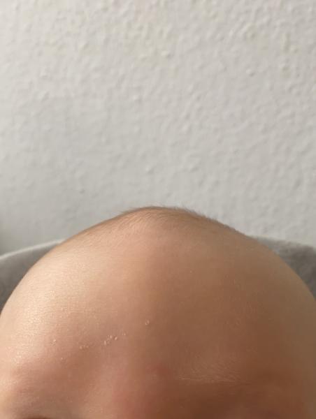 Bild zu Fontanelle gewölbt - Baby Forum - Allgemeine Themen