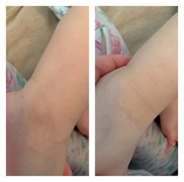 Bild zu Sind das petechien ? - Baby Forum - Allgemeine Themen