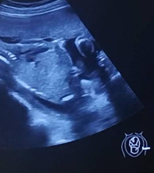 Bild zu Geschlecht erkennen 20. SSW - Baby Forum - Allgemeine Themen