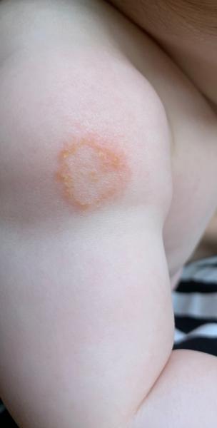 Bild zu Raue und komische Stelle am Arm - Baby Forum - Allgemeine Themen