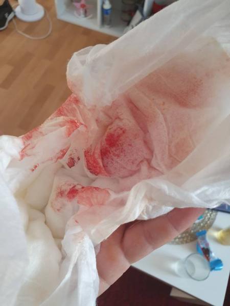 Bild zu Blutung bei Neugeborene - Baby Forum - Allgemeine Themen