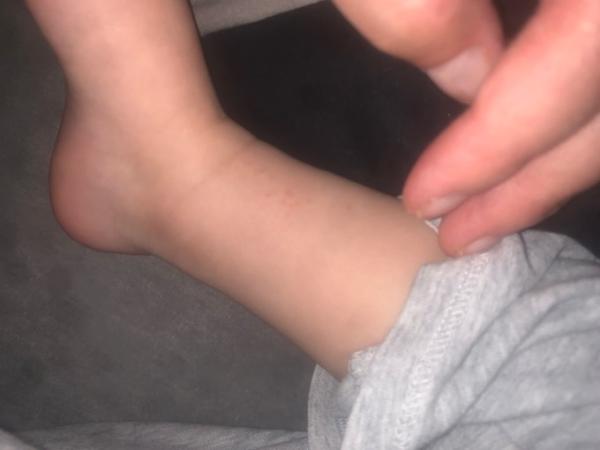 Bild zu Sind das Petechien? - Baby Forum - Allgemeine Themen