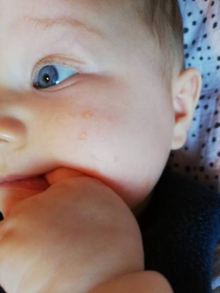 Bild zu Gelbe Krusten im Gesicht - Baby Forum - Allgemeine Themen