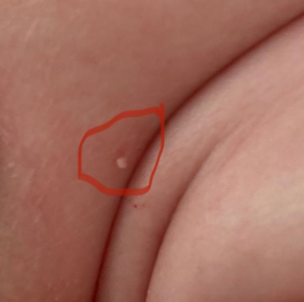 Bild zu Hautanhängsel - Baby Forum - Allgemeine Themen