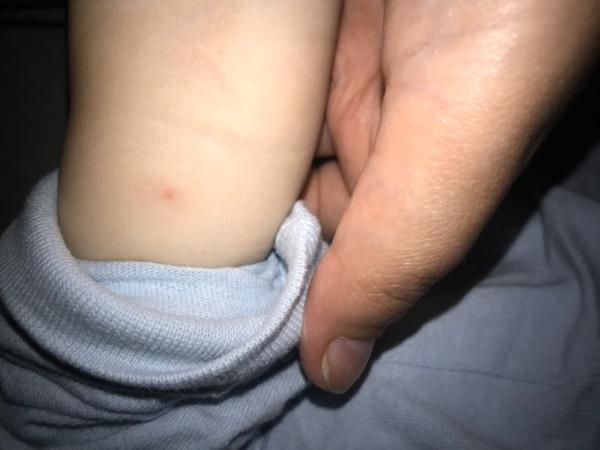 Bild zu An die, die sich besser auskennen. Kann das Zeckebiss sein? - Baby Forum - Allgemeine Themen