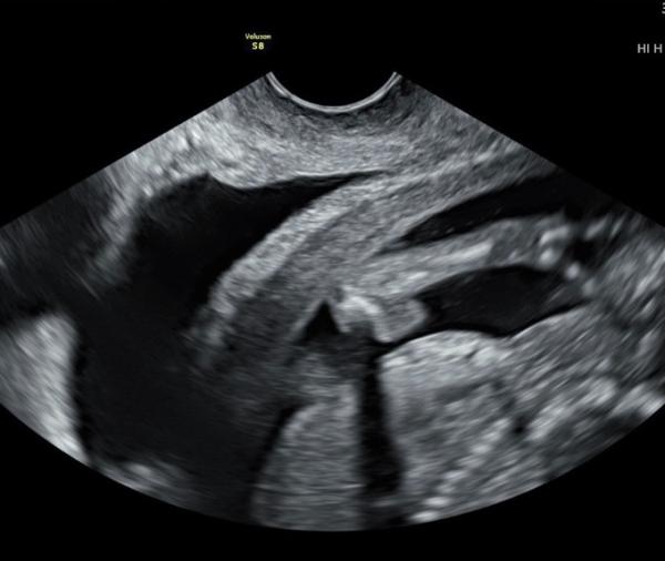 Bild zu Ultraschall: Junge? - Baby Forum - Allgemeine Themen