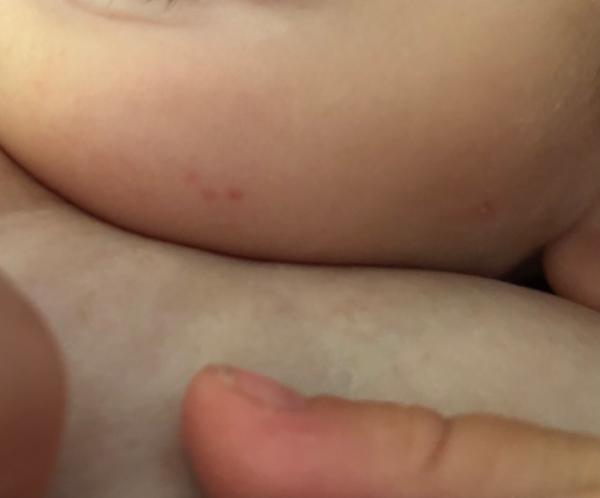 Bild zu Sind das Petechien? - Baby Forum - Allgemeine Themen