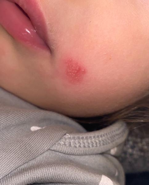Bild zu Herpes ? - Baby Forum - Allgemeine Themen