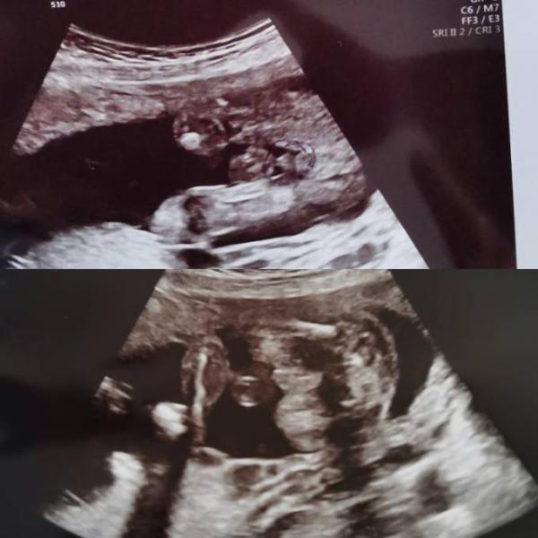 Bild zu Mädchen oder Junge - Baby Forum - Allgemeine Themen