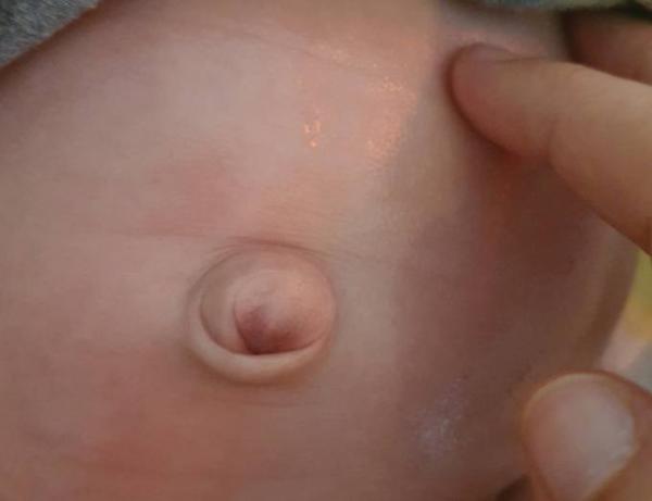 Bild zu Nabelbruch - Baby Forum - Allgemeine Themen