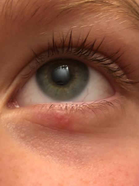 Bild zu Pickelchen unterm Auge - Baby Forum - Allgemeine Themen