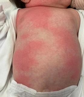 Bild zu Rote Flecken am ganzen Körper - Baby 6 Wochen alt - Baby Forum - Allgemeine Themen