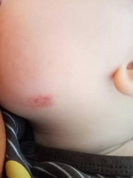 Bild zu Ekzem, Blutschwamm oder was?? - Baby Forum - Allgemeine Themen