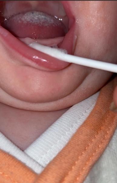 Bild zu Ist das wieder Soor? - Baby Forum - Allgemeine Themen