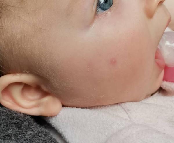Bild zu Was ist das für ein pickel - Baby Forum - Allgemeine Themen
