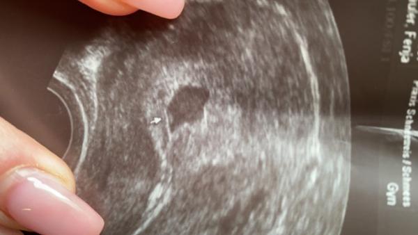Bild zu Kein Embryo ? - Baby Forum - Allgemeine Themen